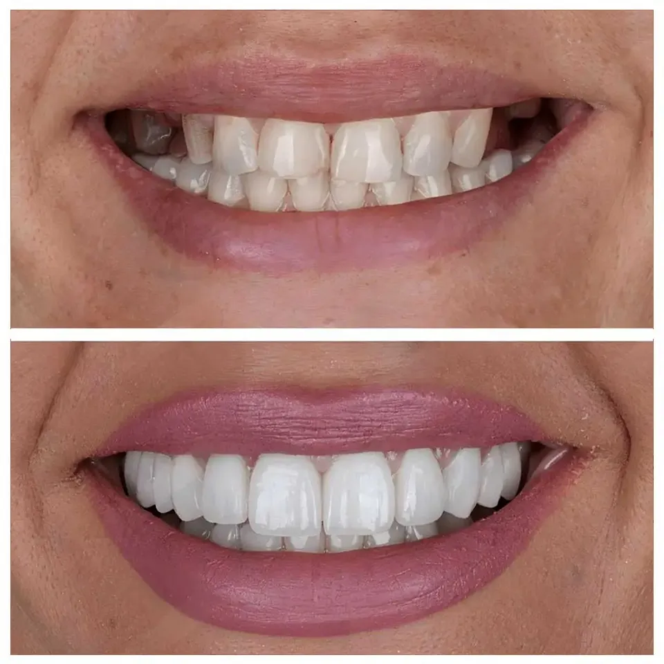 Implant supported stability for everyday comfort