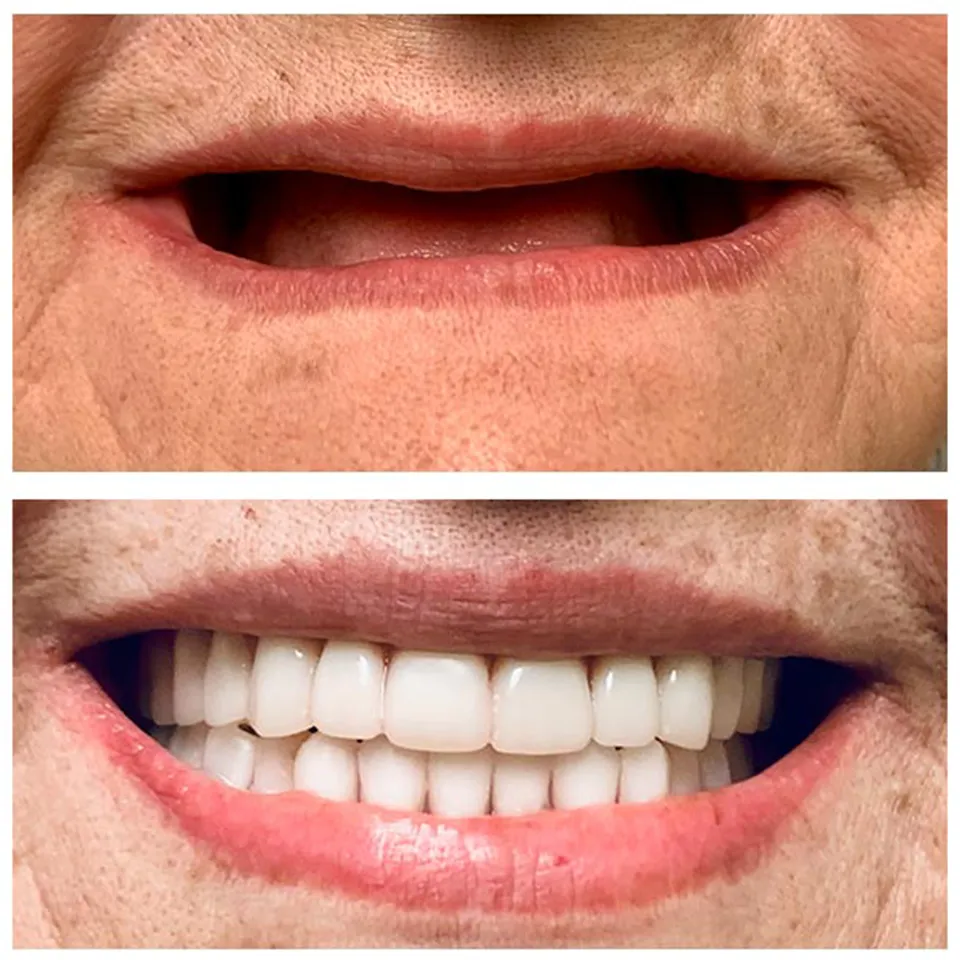 Custom dentures created in our onsite lab